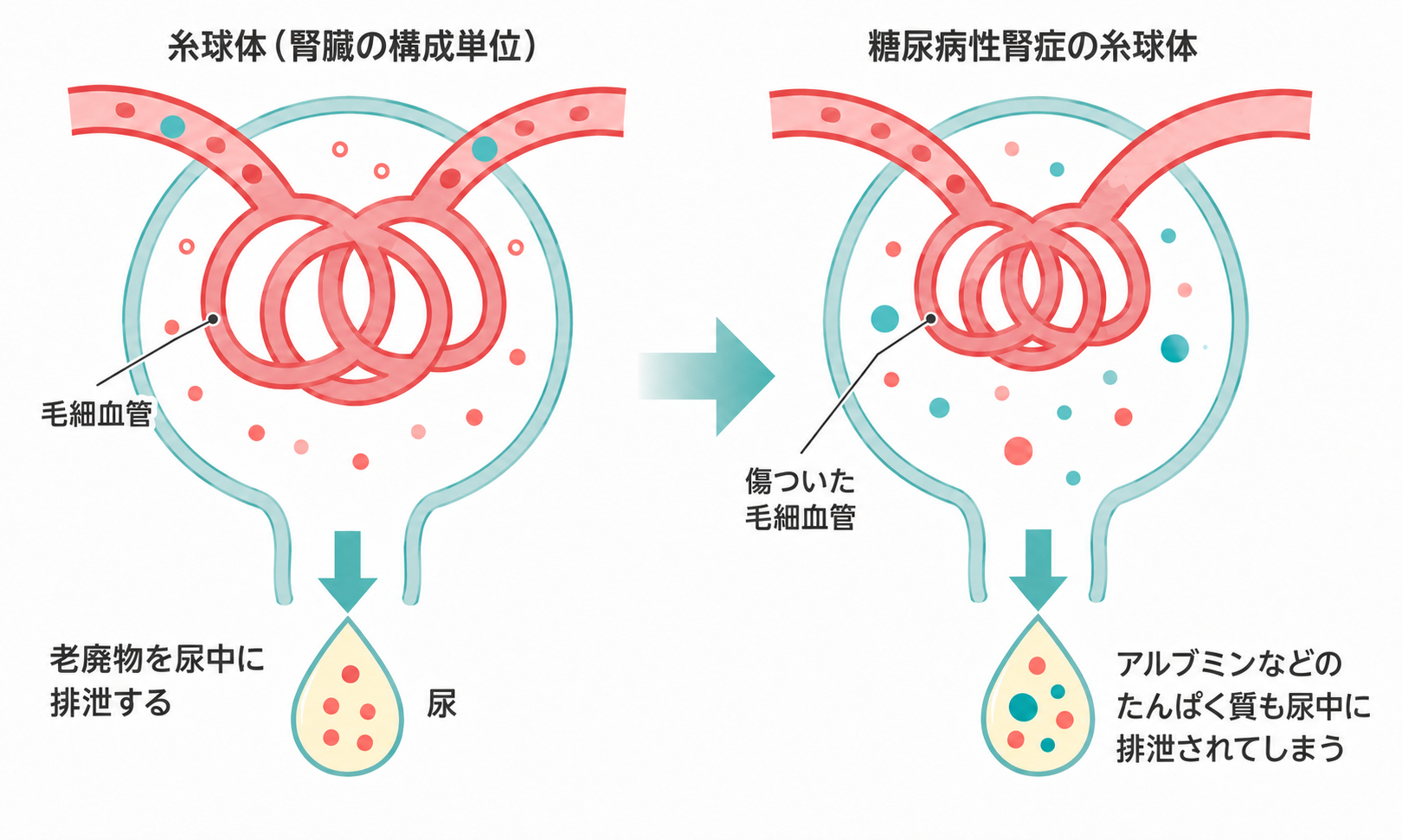 糸球体(腎臓の構成単位)と糖尿病性腎症の糸球体の比較
