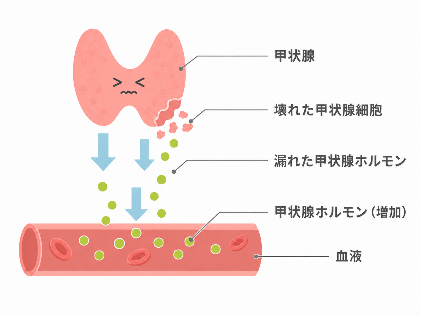甲状腺ホルモンが血中に漏れでる