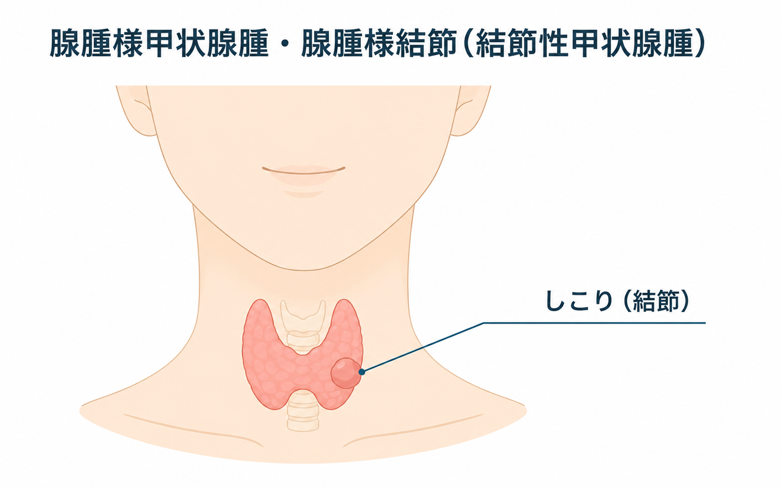 腺腫様甲状腺腫・腺腫様結節のイメージ図