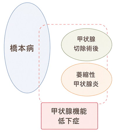 甲状腺機能低下症の原因